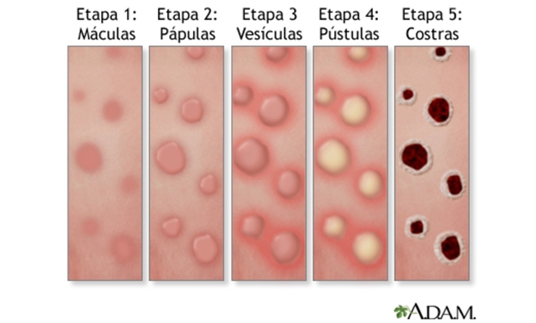 Recomendaciones para  prevenir la Mpox (viruela smica o viruela del mono)